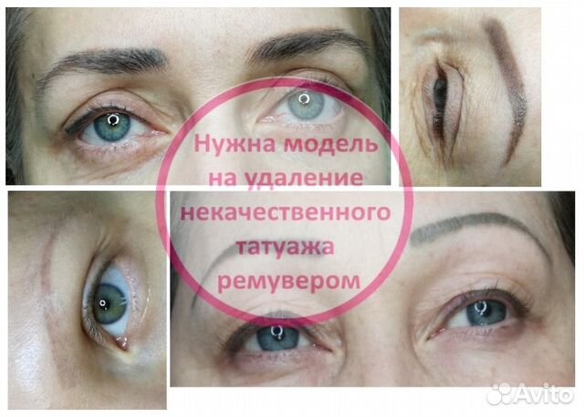 Удаление татуажа ремувером, лазером Удаление татуажа ремувером, лазером