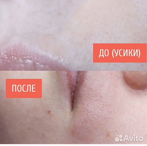 Депиляция (шугаринг) мужская и женская