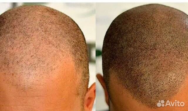 Трихопигментация алопеция головы камуфляж залысин