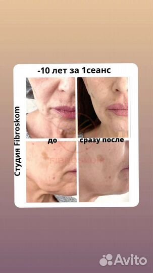 Контурная пластика