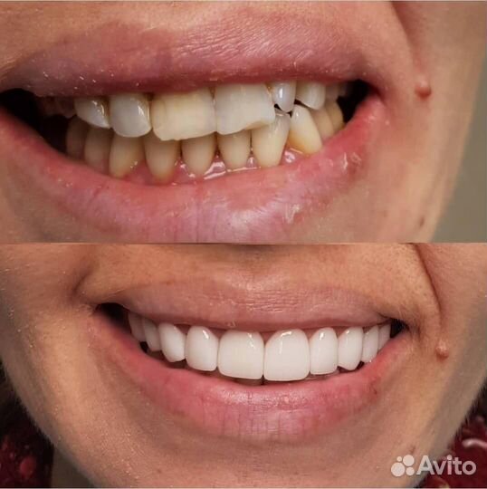 Съемное и несъемное протезирование в Акуле