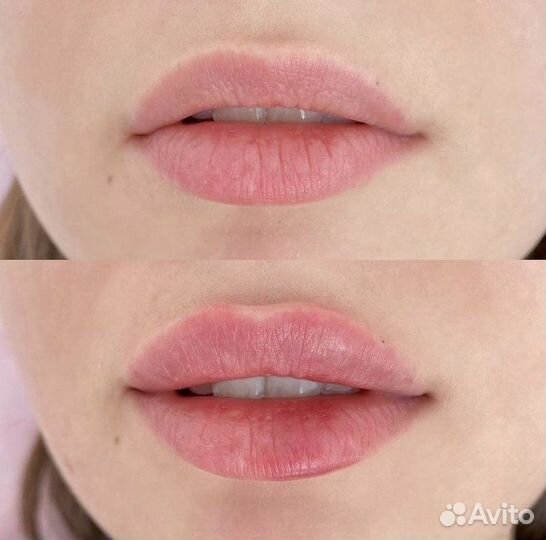 Увеличение губ, ботулинотерапия