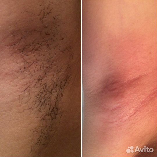 Депиляция воском, шугаринг