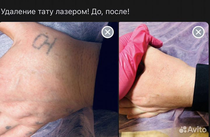 Лазерное удаление тату, татуажа
