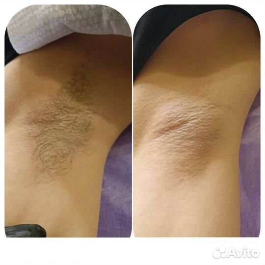 Депиляция шугаринг