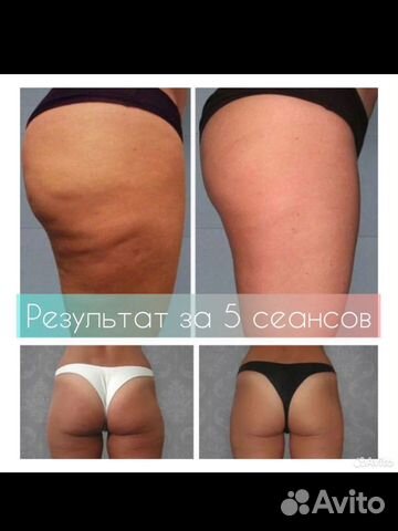 Аппаратный +Вакуумный массаж + RF-лифтинг