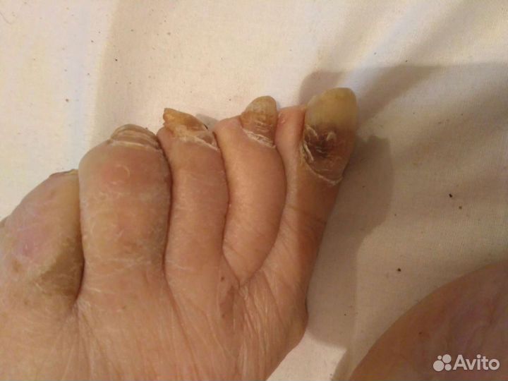 Педикюр. Медицинский педикюр. С выездом на дом