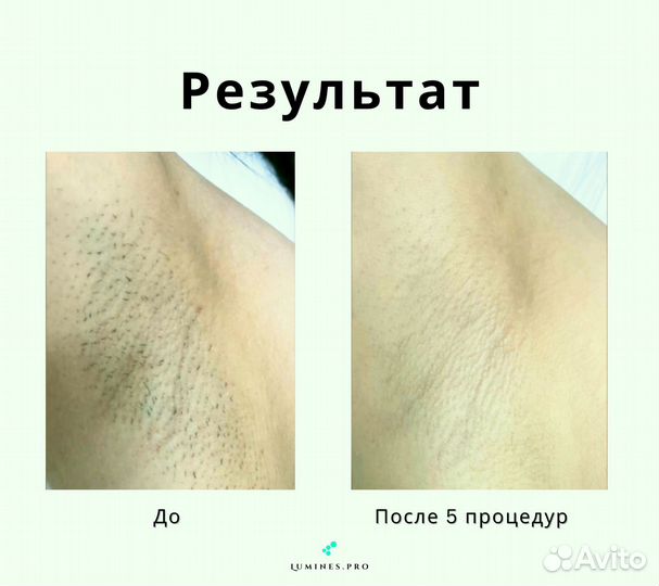 Диодный лазер люминес Макс’Ван 1200 Вт