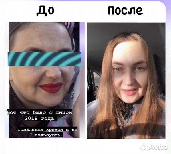 Крем против пигментации