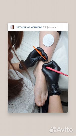 Электроэпиляция