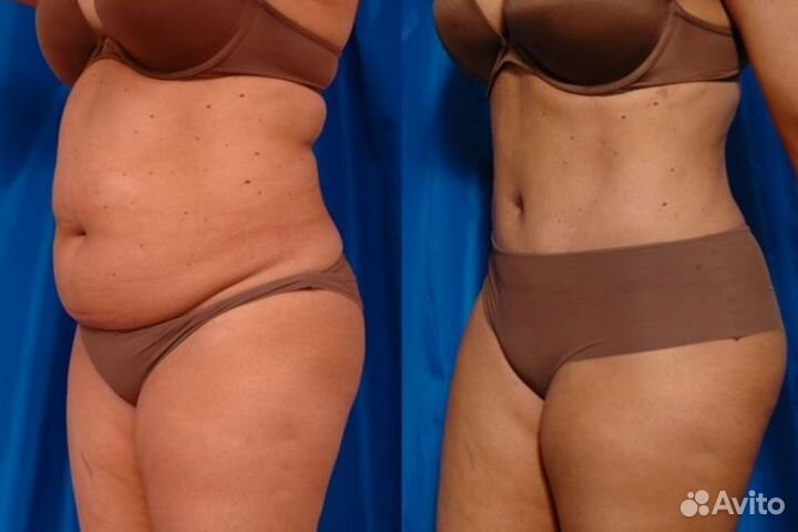 Путь к уменьшению жировой прослойки в Барнауле