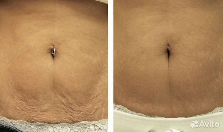 Смас лица, тела, подтяжка фигуры