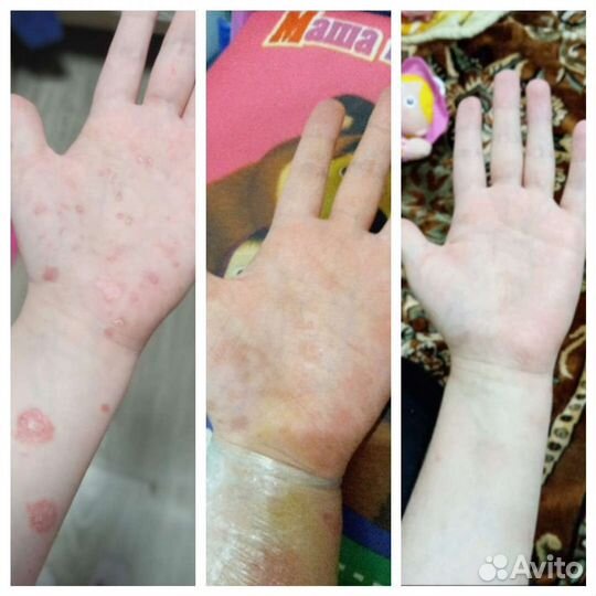 Мазь от проклятого псориаза 200гр