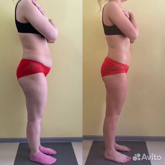 Прессотерапия