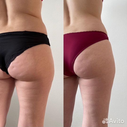 Антицеллюлитный LPG массаж, коррекция фигуры