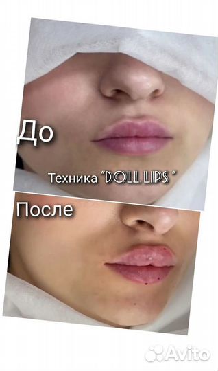 Контурная пластика губ, лица, тредлифтинг-мононити