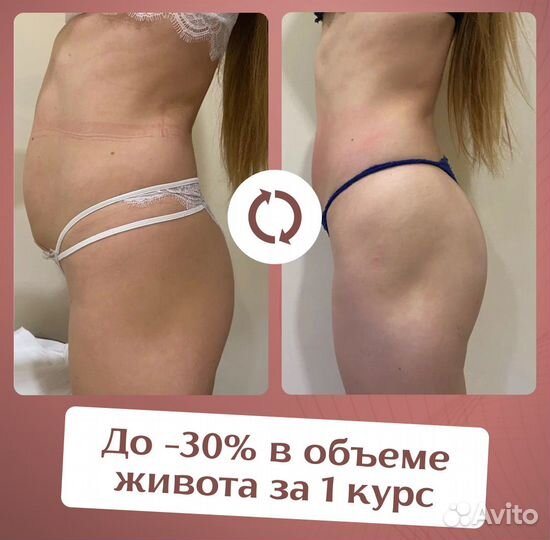 LPG-массаж. Технологии для похудения