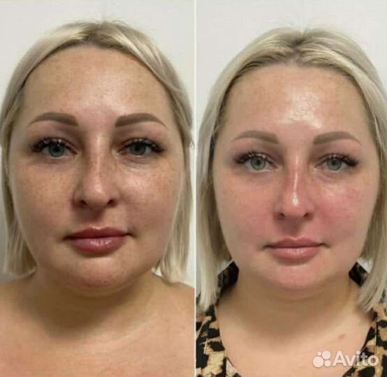 Скульптурный массаж лица