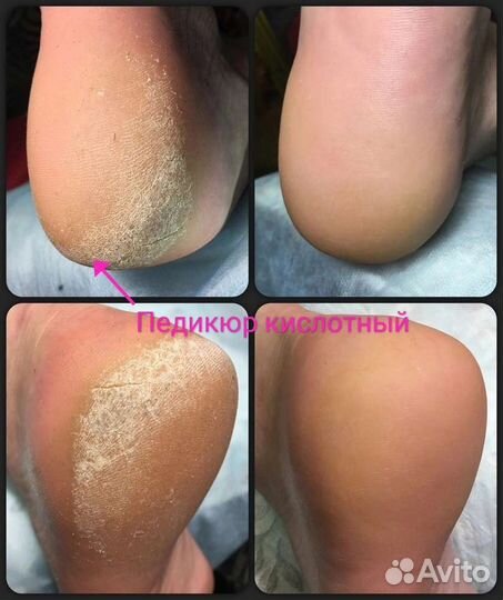 Педикюр Мужской/Женский Кислотный/Щелочной