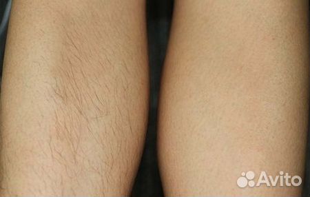 Сахарная депиляция