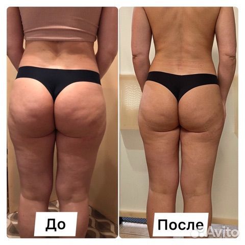 Антицеллюлитный массаж ручной