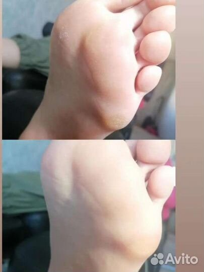 Выравнивание ногтевой пластины