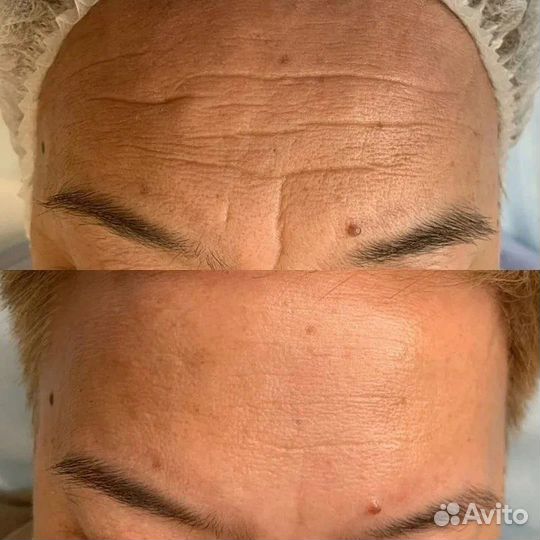 Игольчатый РФ лифтинг РФ лифтинг