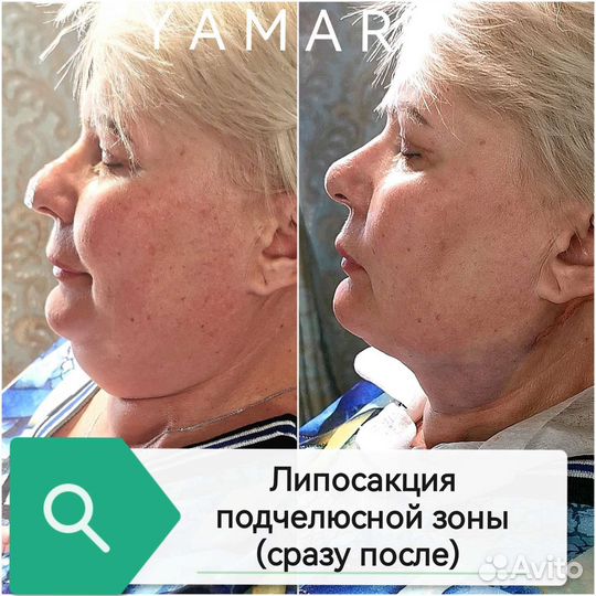 Липоредукция подбородка. Косметолог