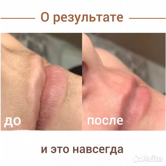 Электроэпиляция