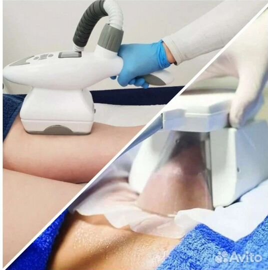 Модель на криолиполиз