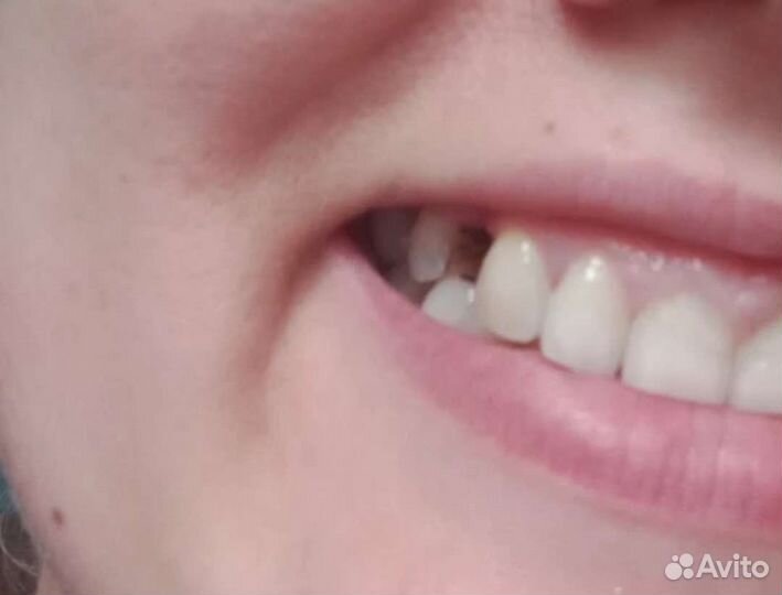 Литые горошки для зубов цена за 1 пакет