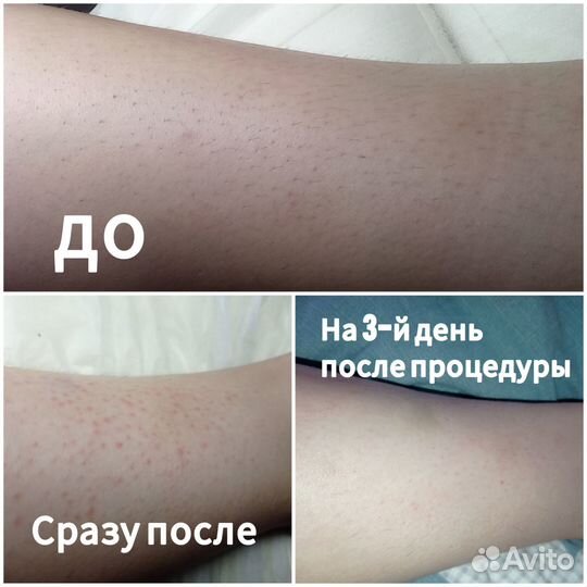 Мастер электроэпиляции