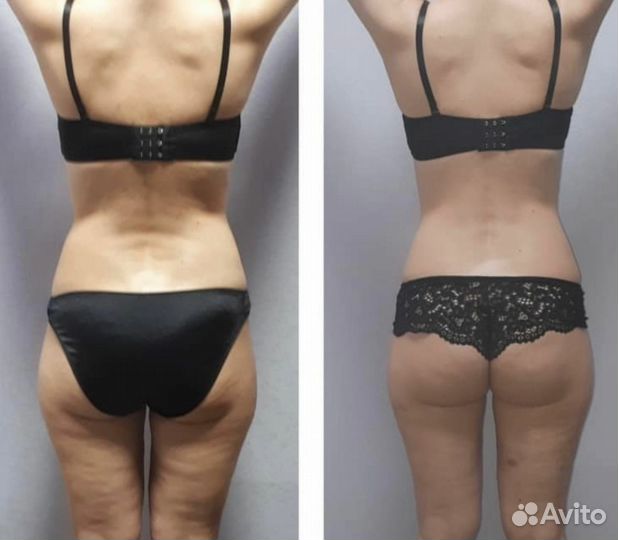 Lpg массаж, кавитация, вакуум, коррекция фигуры