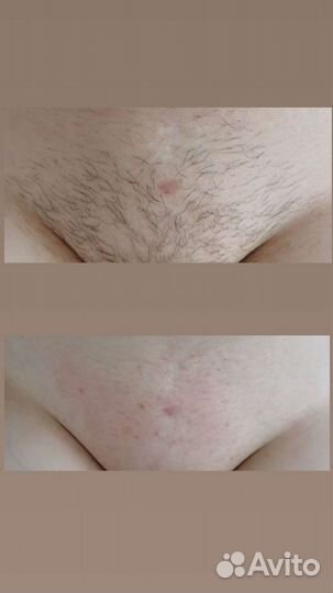 Шугаринг. Воск