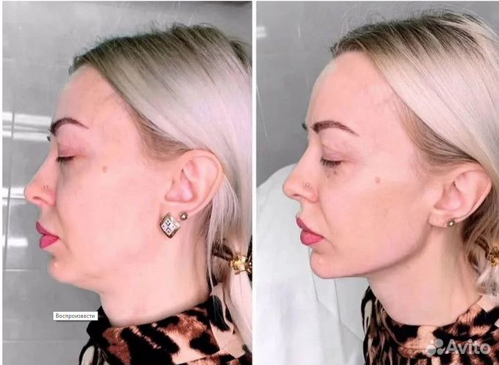 Супер омоложение и подтяжку лица без уколов