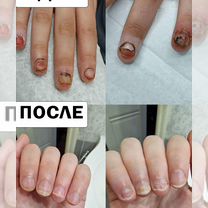 Лазерное лечение грибка ногтей Подолог, Москва