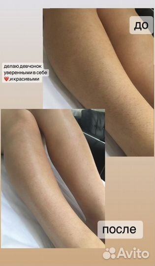 Восковая депиляция,Шугаринг