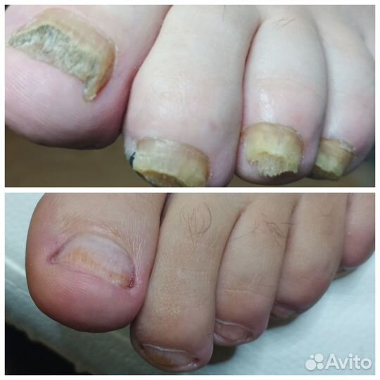 Педикюр, подолог