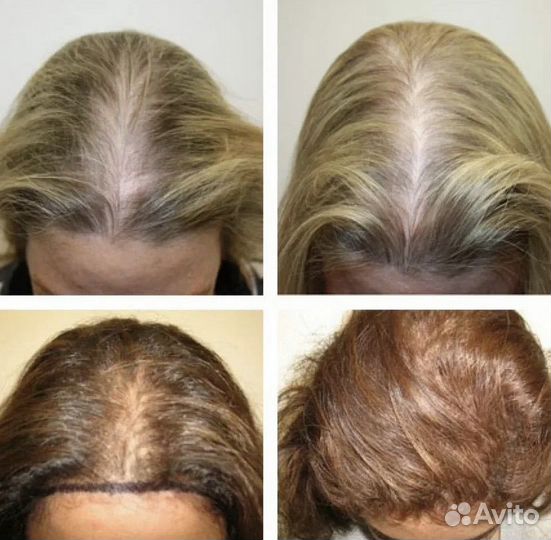 Мезотерапия волос