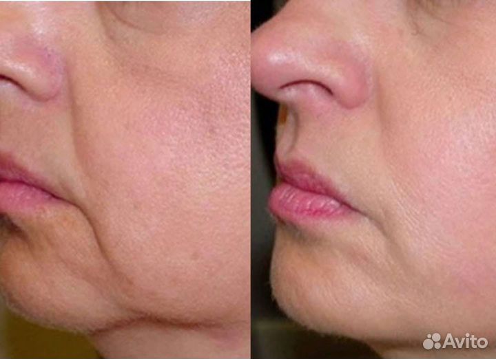 Скульптурно - буккальный лифтинг массаж лица