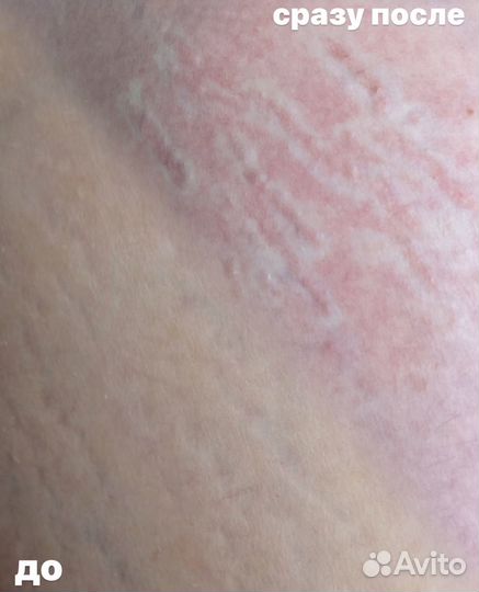 Камуфляж шрамов, цветокоррекция ареол, растяжки