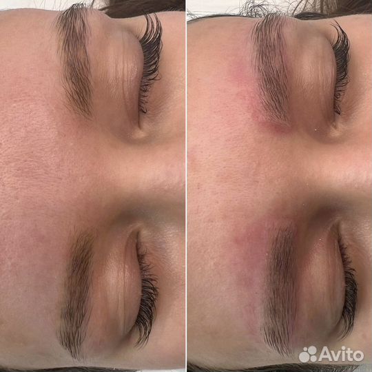 Удаление татуажа ремувером revivink plus ревайвинк