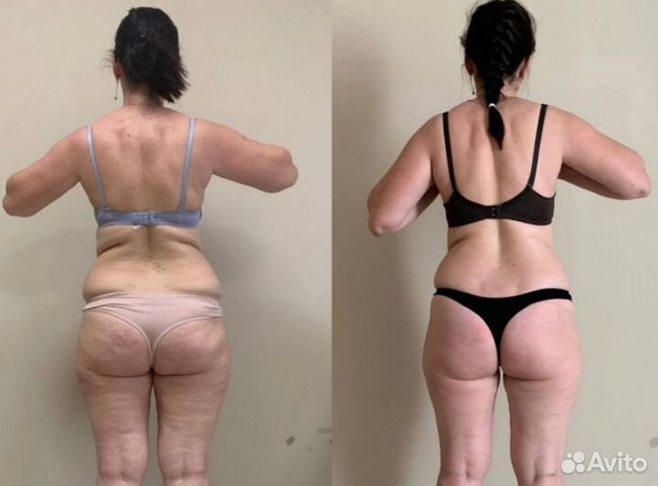 Аппаратная коррекция фигуры, антицеллюлитная