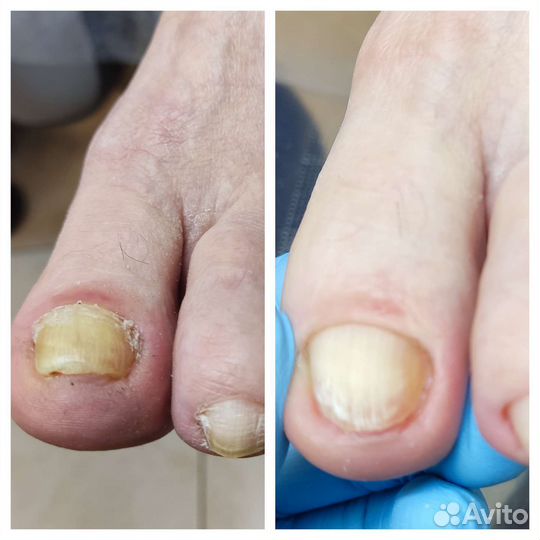 Лечебный педикюр,подолог