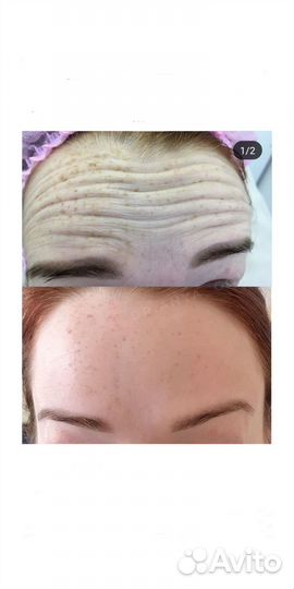 Удаление морщин