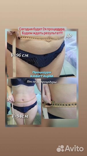 Аппаратная коррекция фигуры. Красивое тело