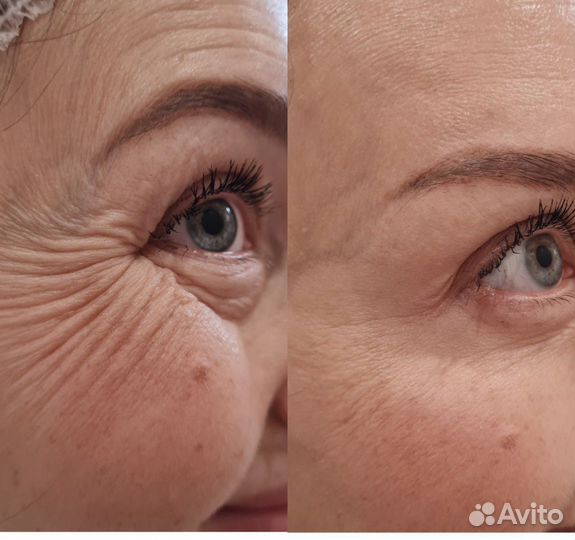 Ботокс для лица