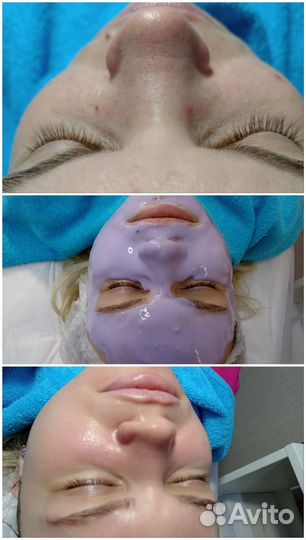Элос - омоложение, эпиляция, чистка лица
