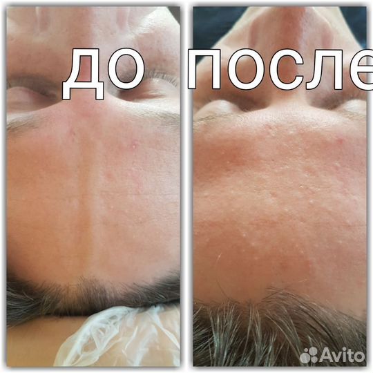 Лифтинг RF, кавитация, микротоки, миостимуляция