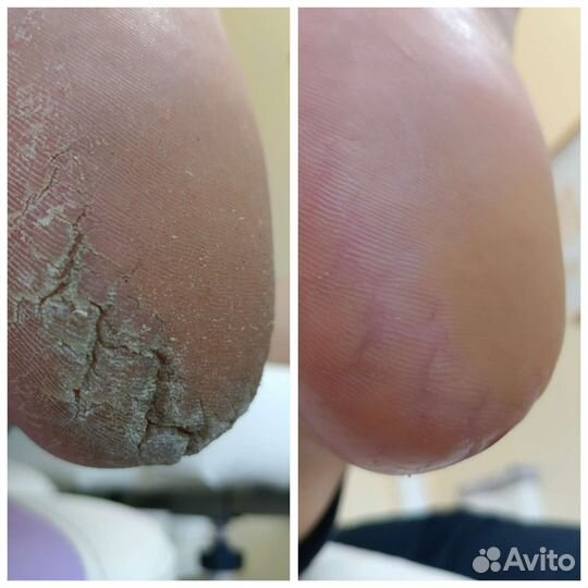 Педикюр аппаратный.парамедицинский